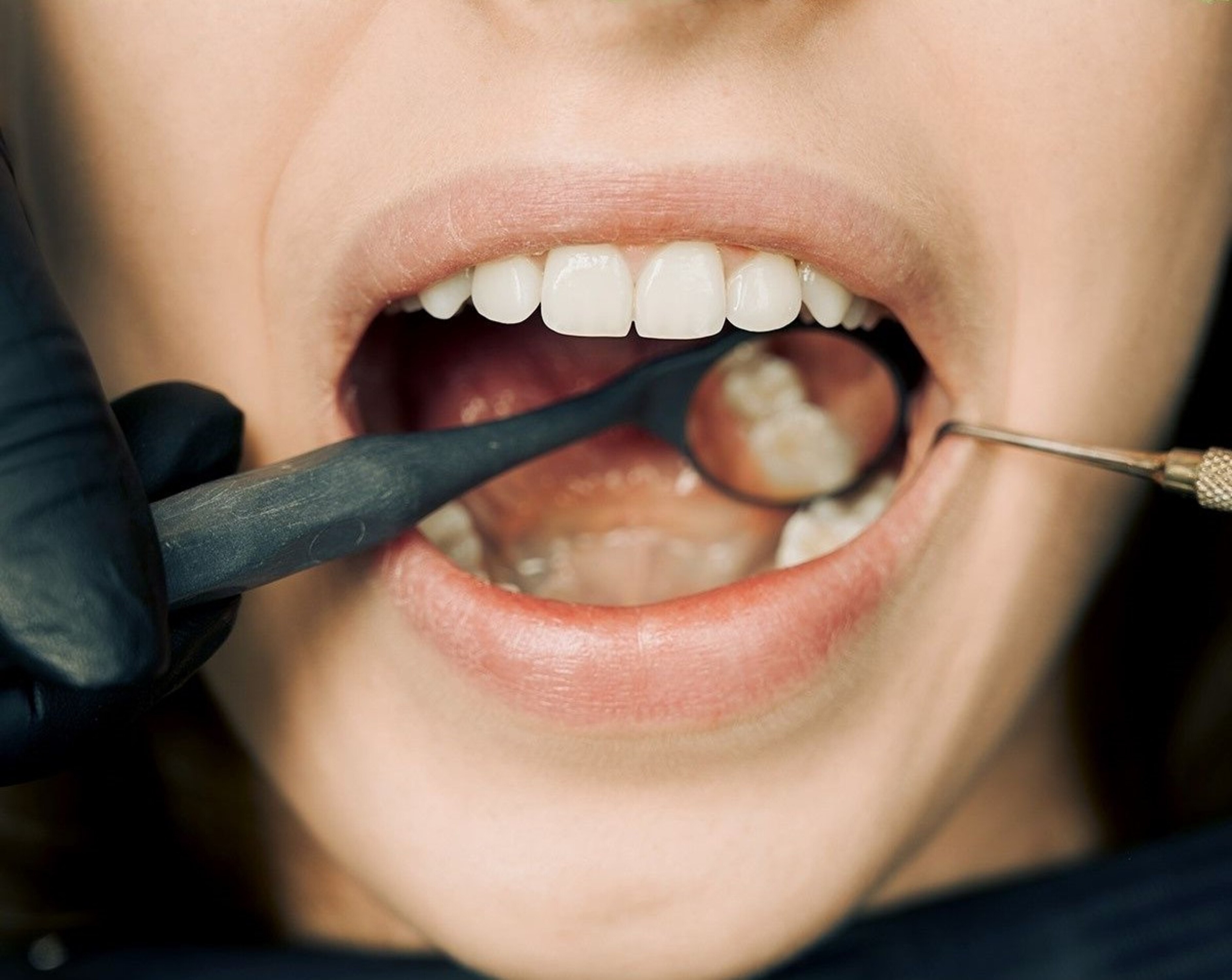 Por que o dente do siso não nasce em algumas pessoa?